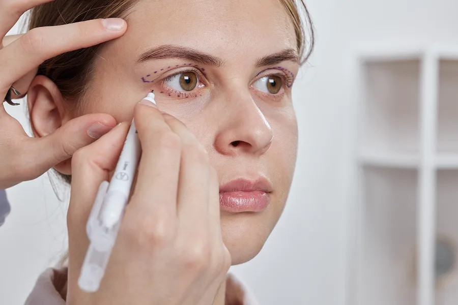 Corrección de ptosis vs. blefaroplastia: ¿Qué cirugía de párpados es la adecuada para usted?