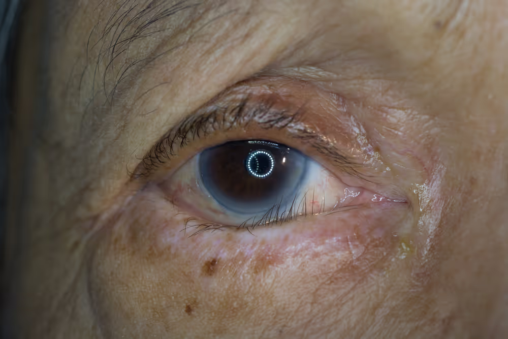 Primer plano de un ojo con una afección corneal.